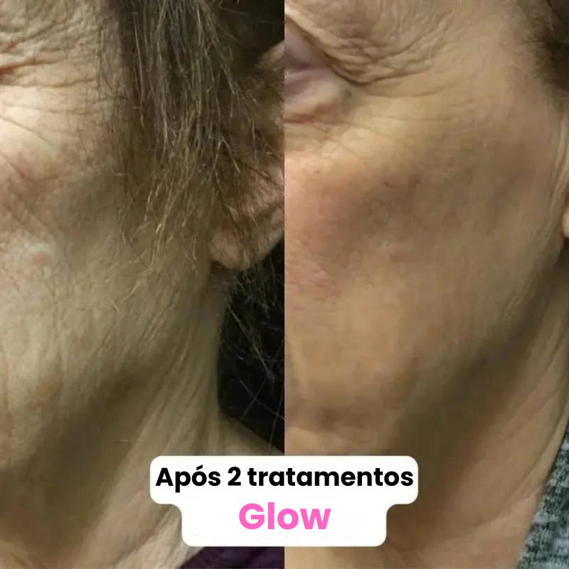 GLOW PELE INFUSION SYSTEM