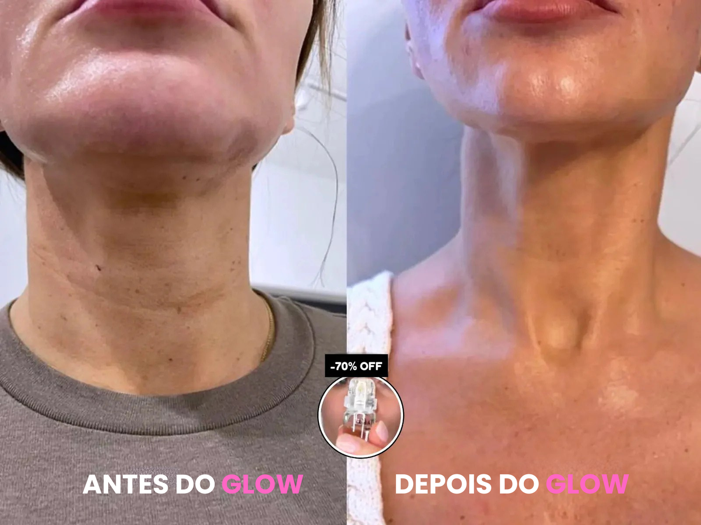 Meu pescoço flácido e minhas linhas de sorriso FINALMENTE SUMIRAM!